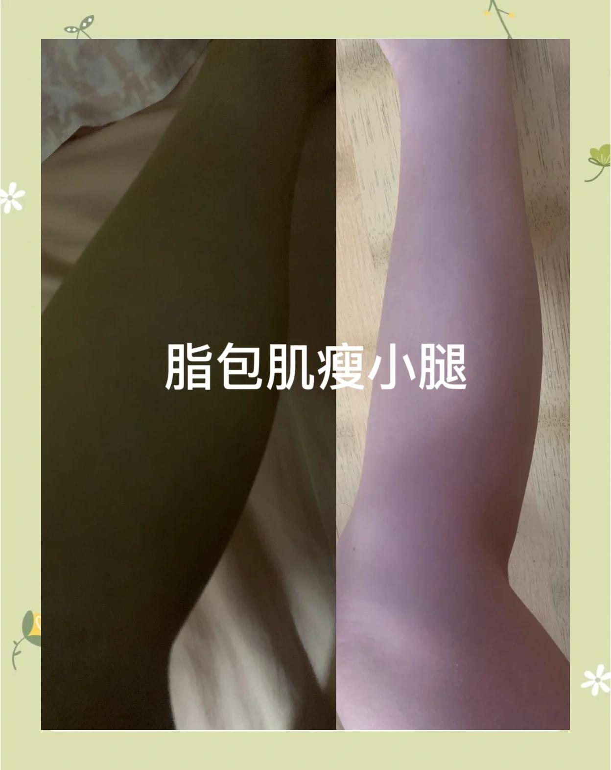 小腿抽脂后该注意什么?