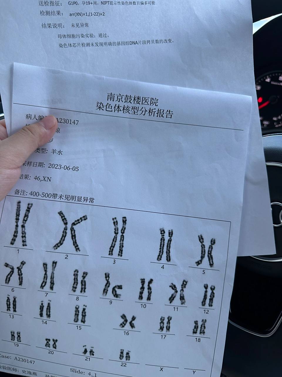 无创dna能看出男女吗