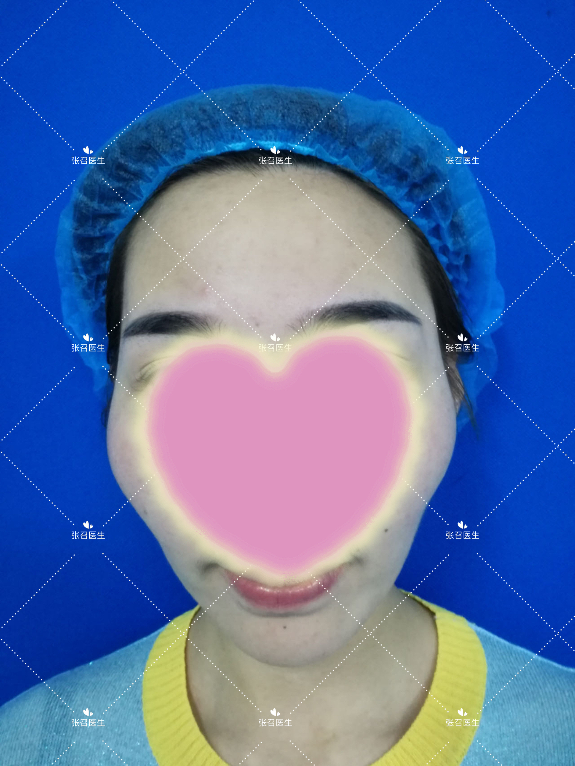 颧骨突出!!!!!!