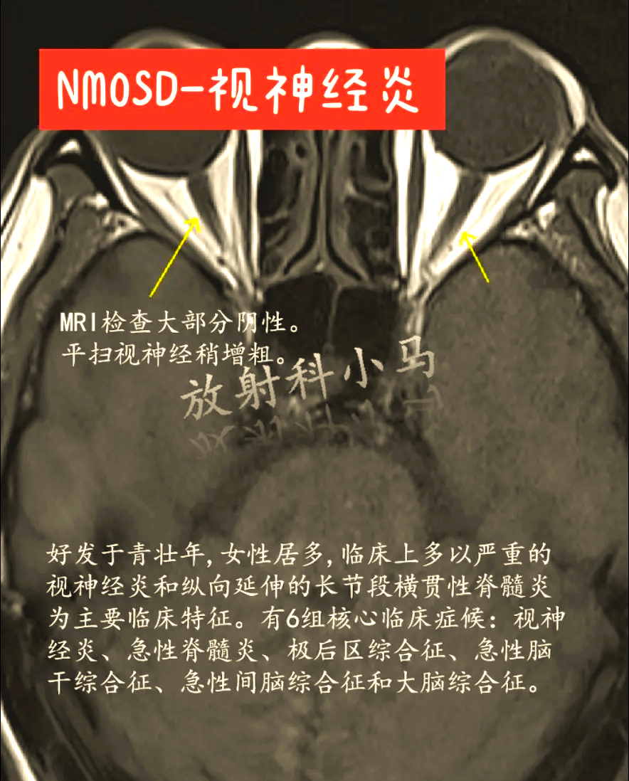 脊髓炎有哪些症状?