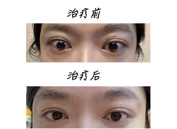 轻微的甲亢可以自愈吗