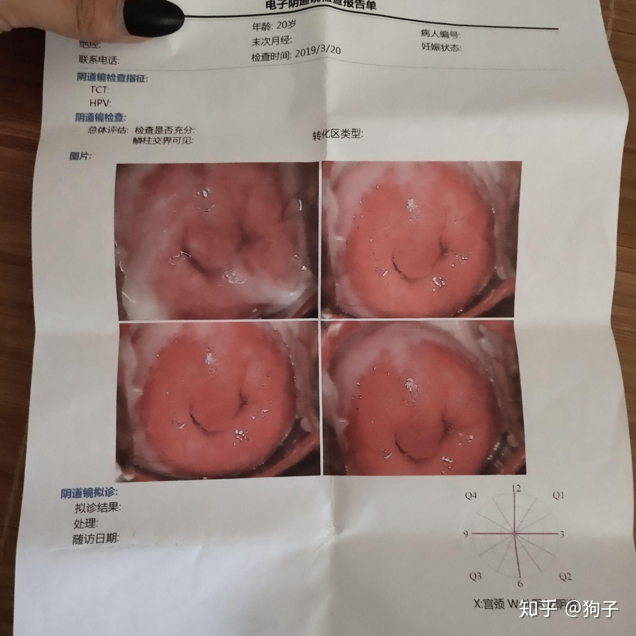 宫颈糜烂到底是什么