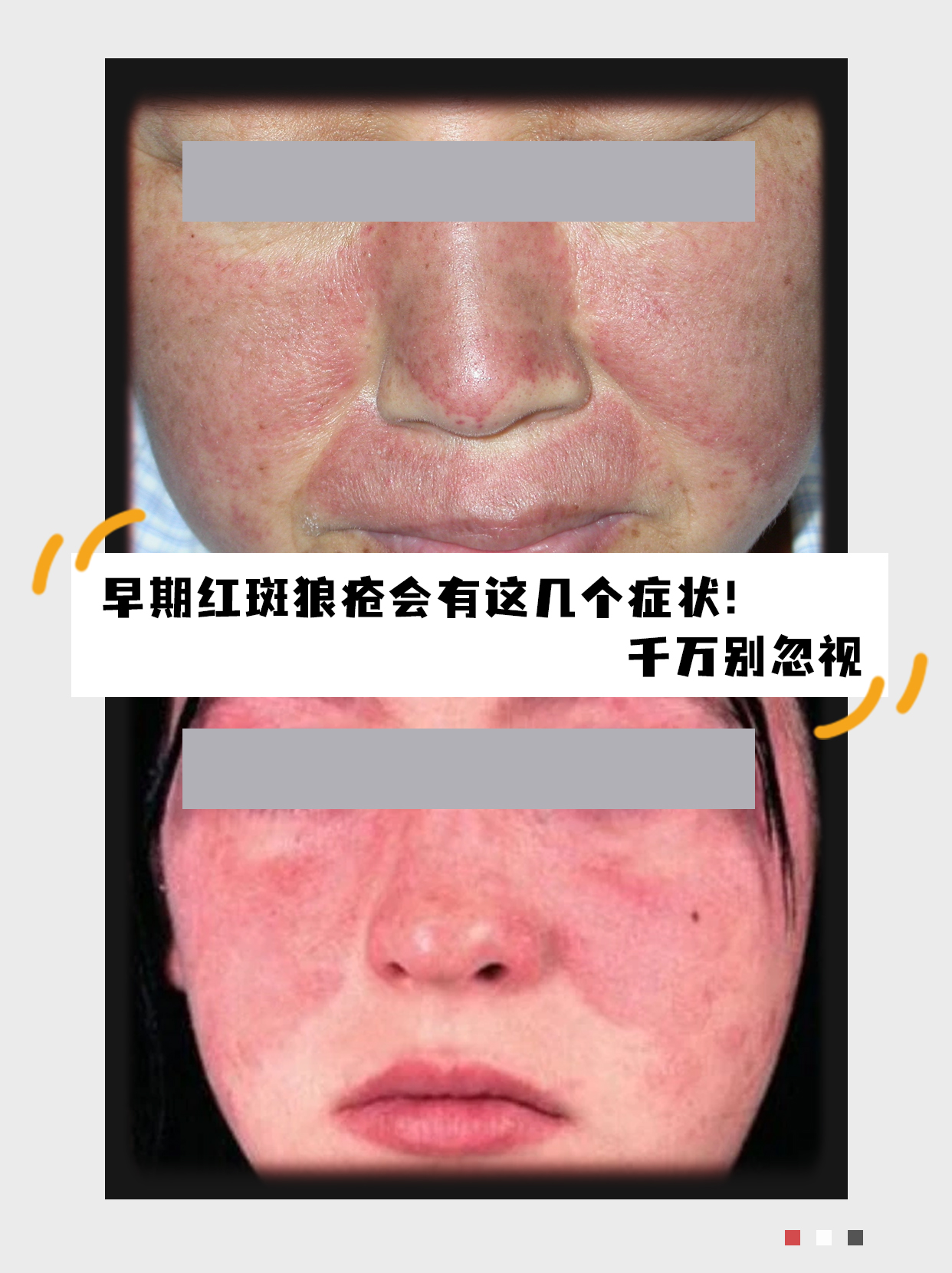 红斑狼疮是怎么得来的啊