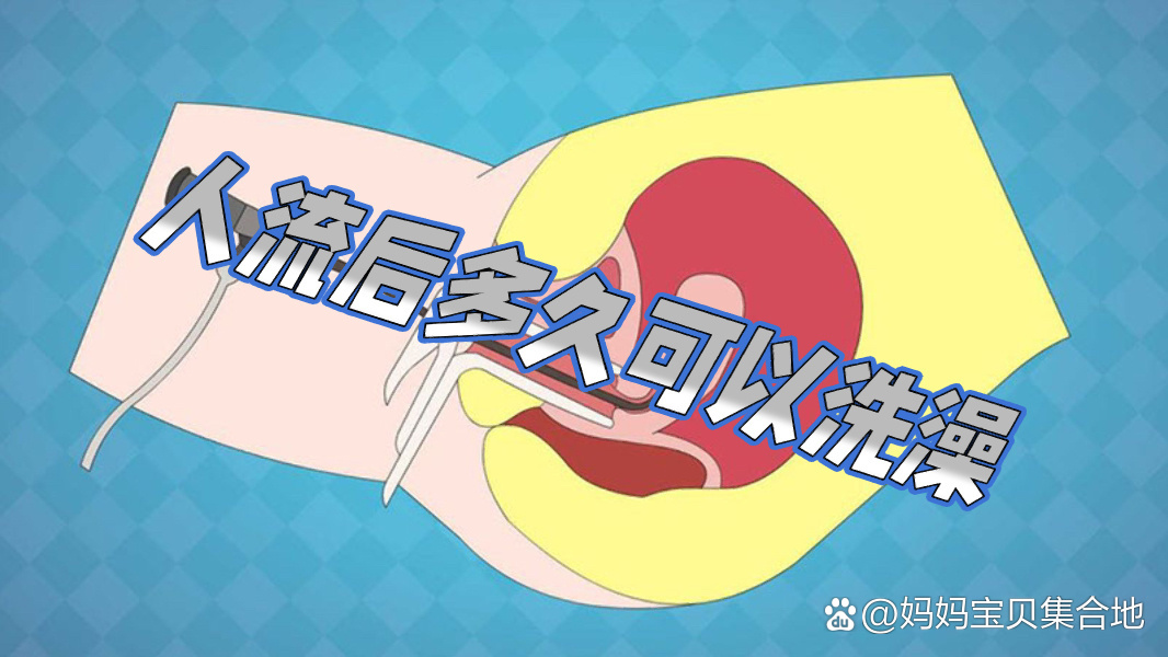 无痛人流后能洗澡吗