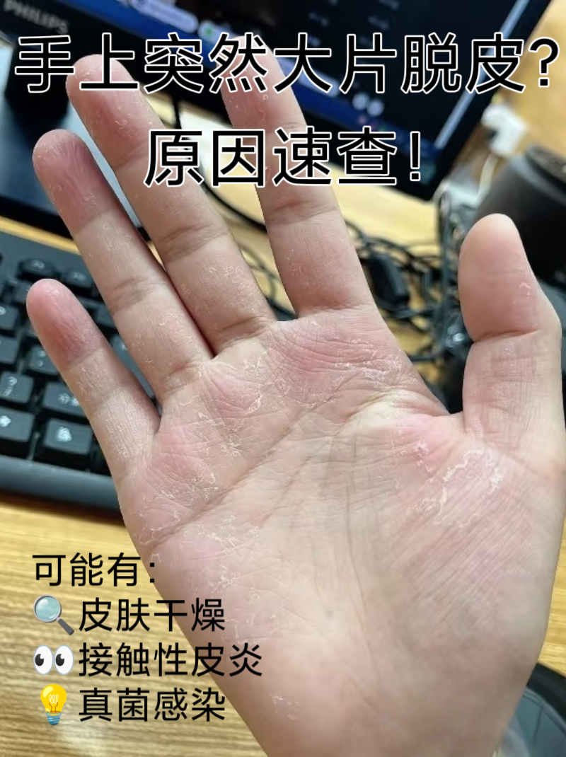 手脱皮很严重什么原因