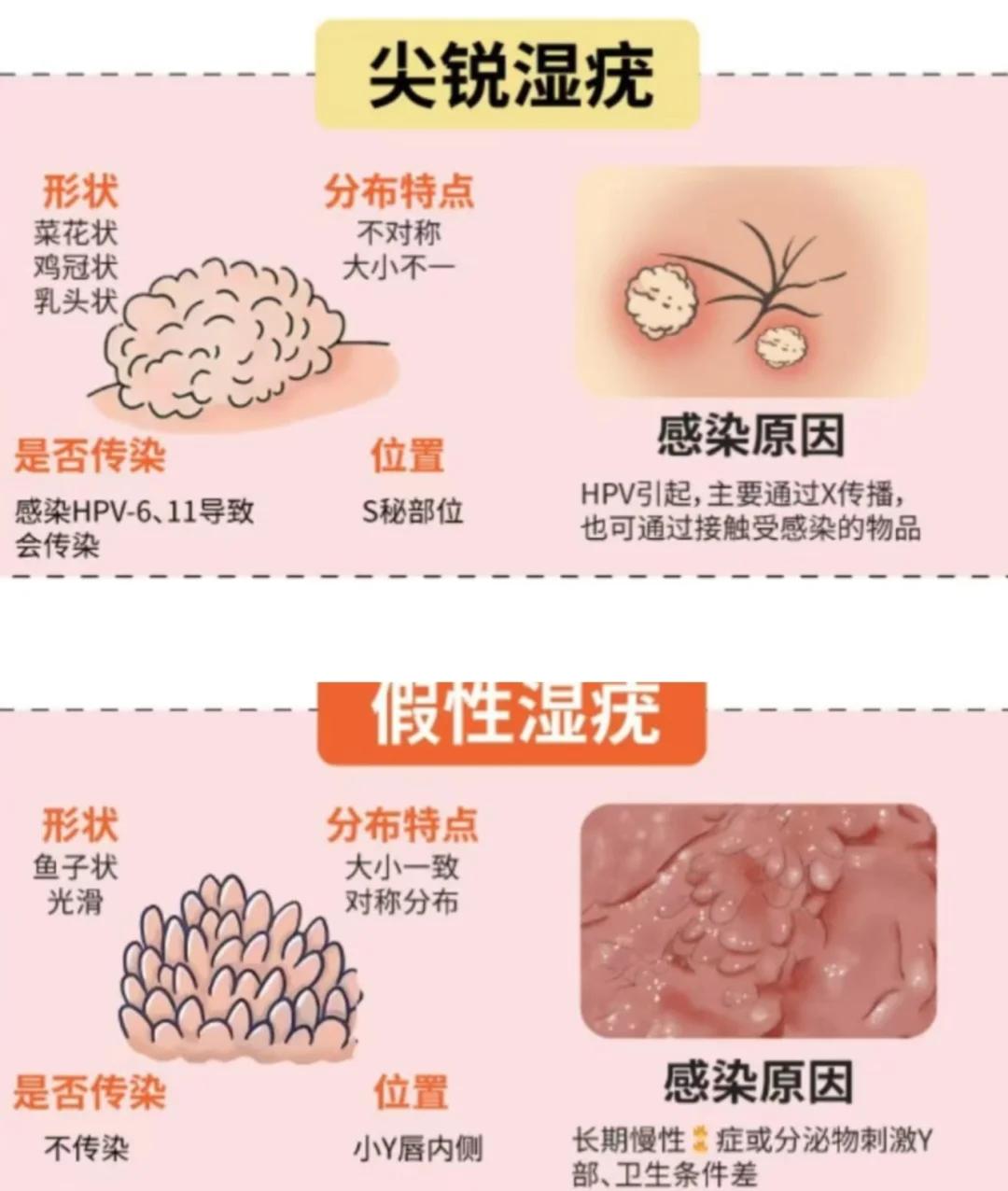 假性尖锐湿疣怎么消除?