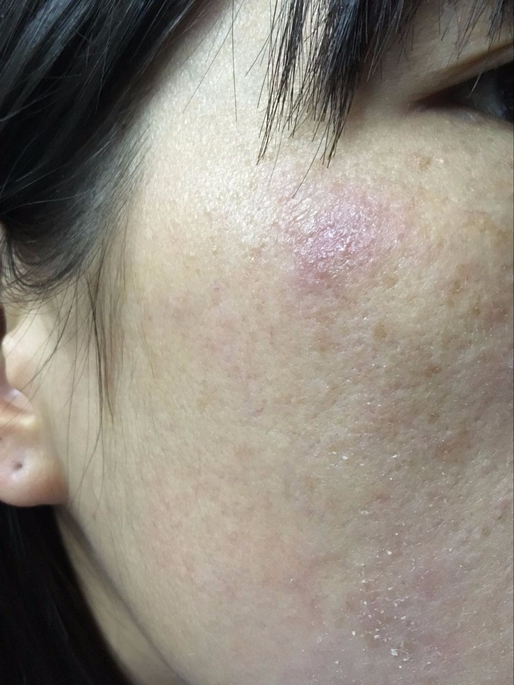 脸上红红的一片,很痒