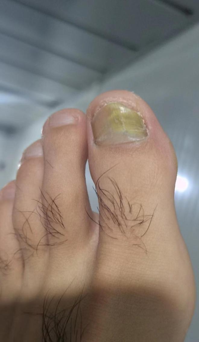 脚指甲变黄是怎么会事