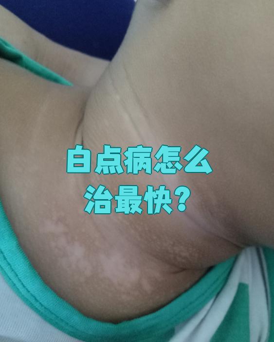 身上有块白斑是什么
