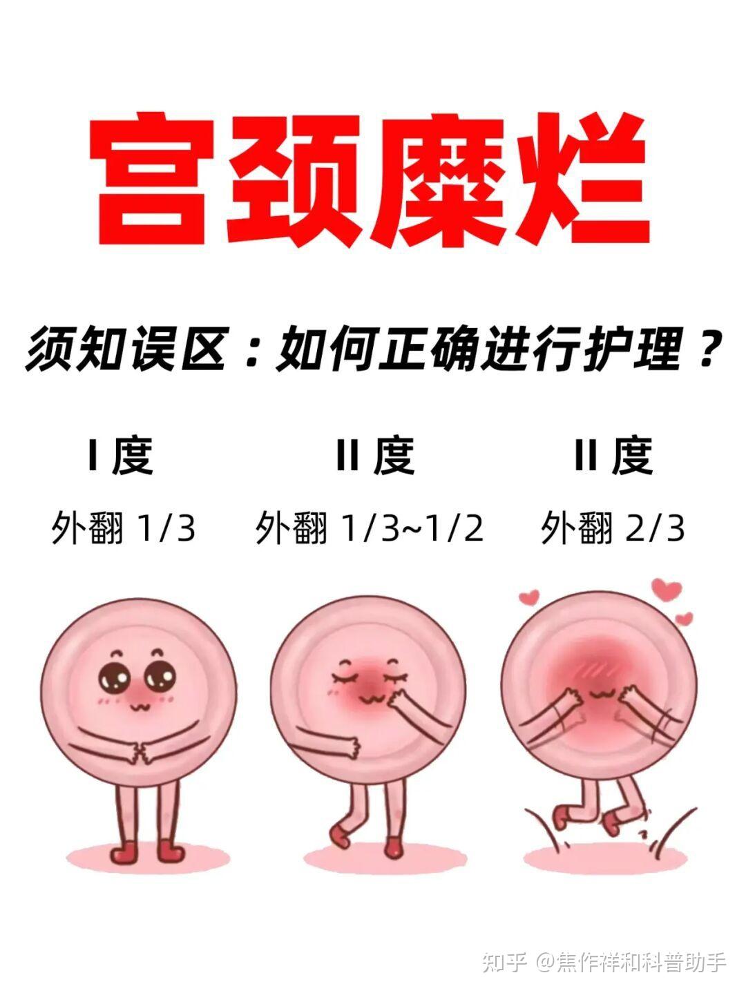 宫颈糜烂8年了会癌变吗