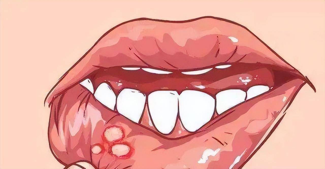 口腔溃疡会自愈吗