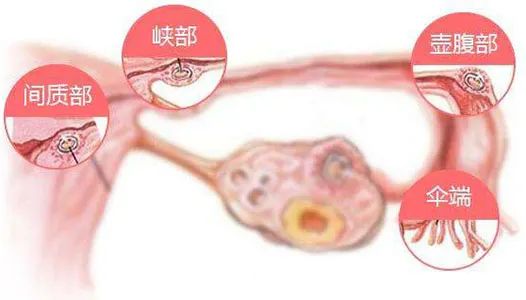 什么原因导致输卵管堵塞