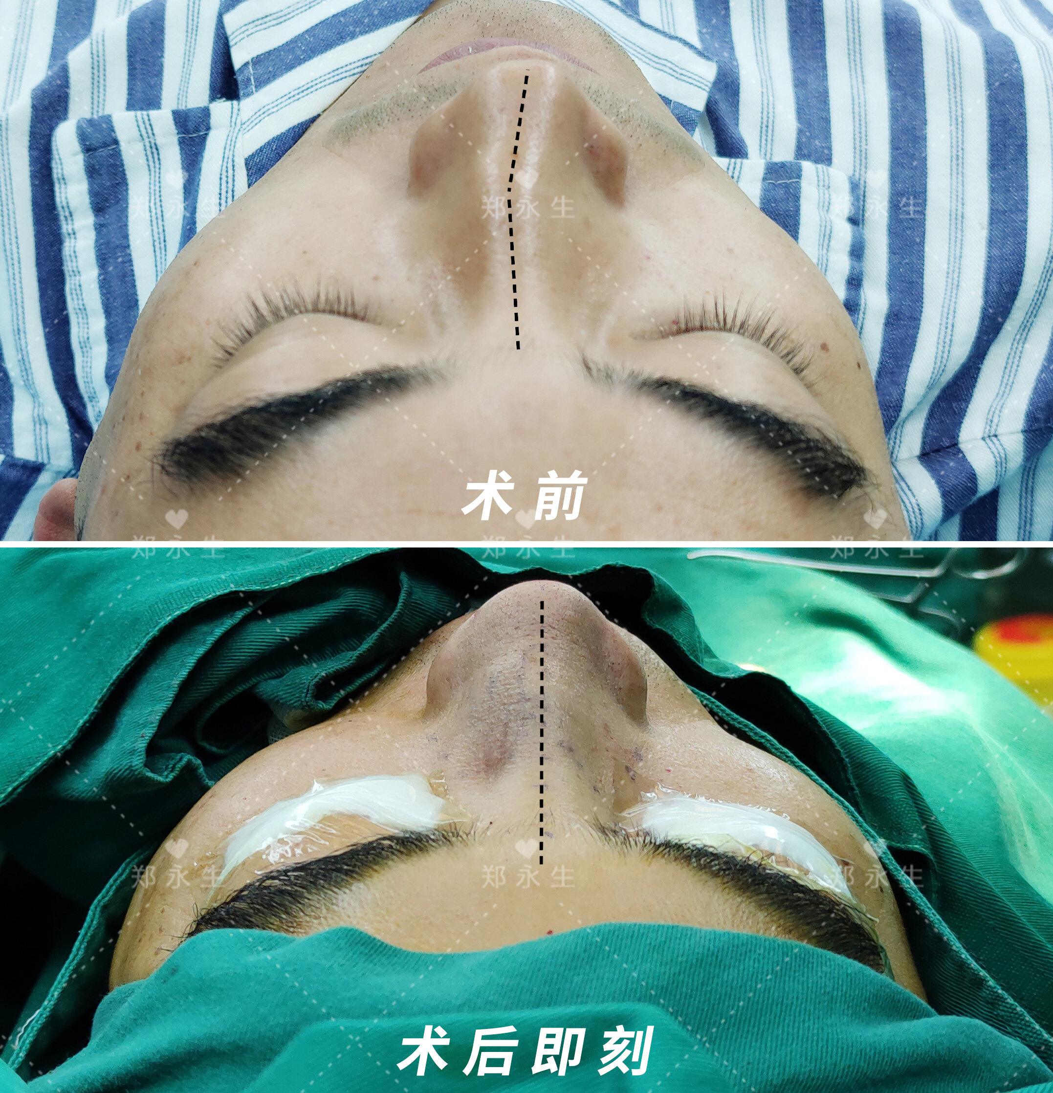鼻中隔矫正术的后遗症