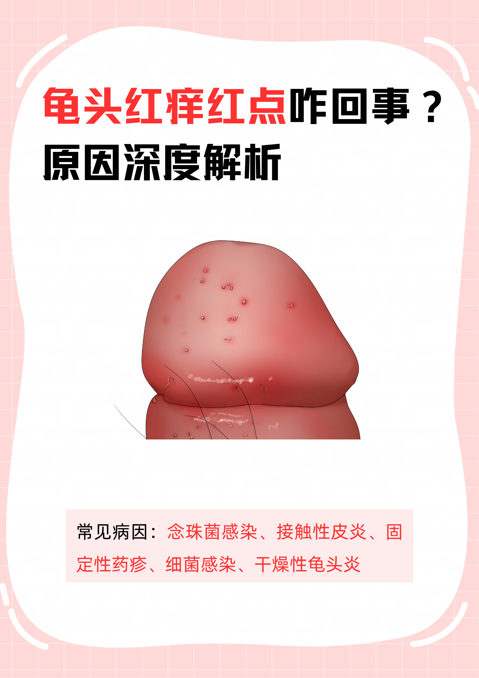 白色念珠菌感染症状有哪些