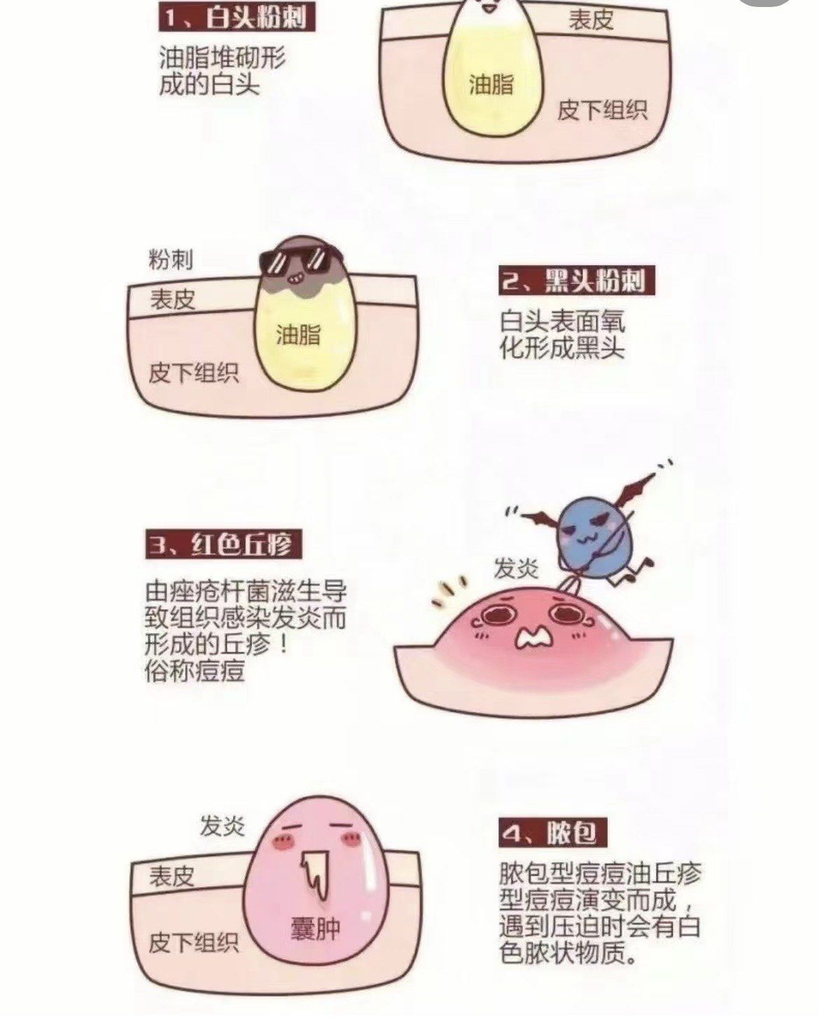 痤疮形成的原因