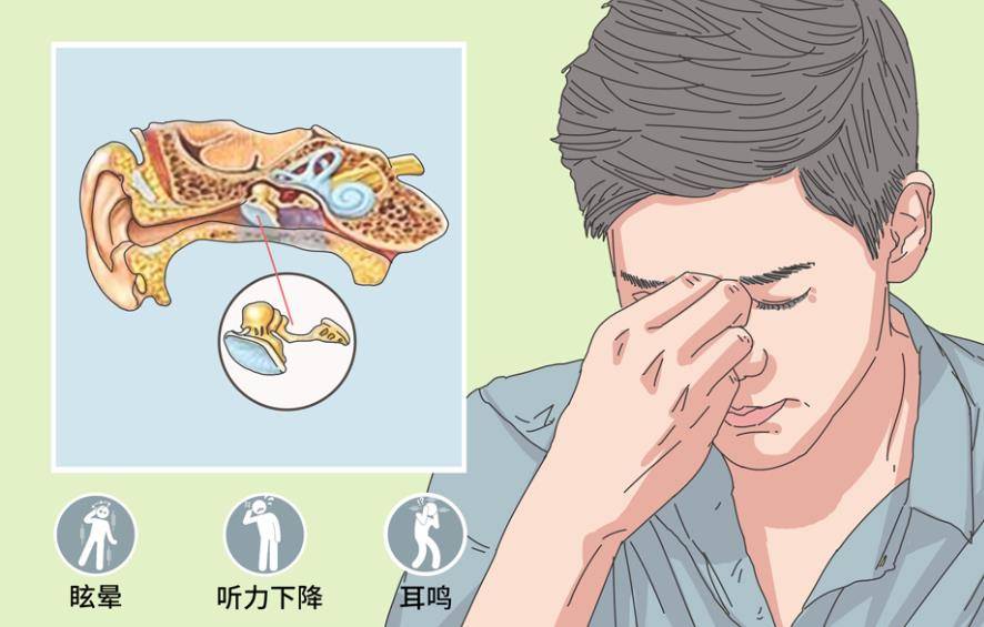 分泌性中耳炎的症状有几种