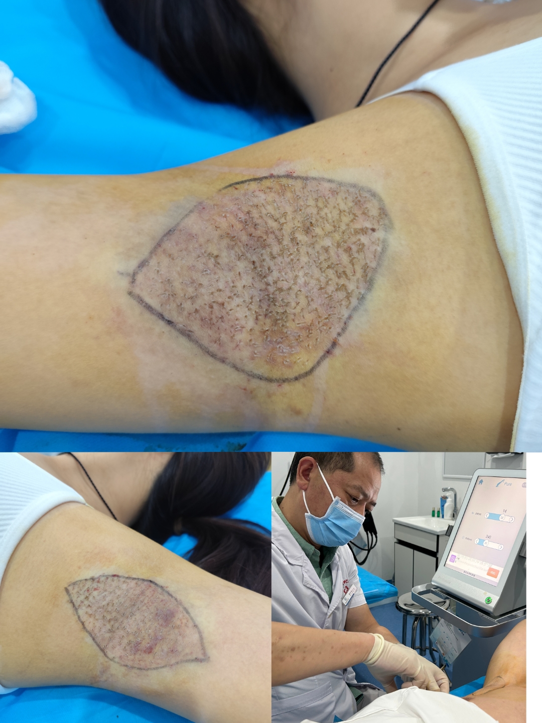 腋臭微创手术是什么意思?求解