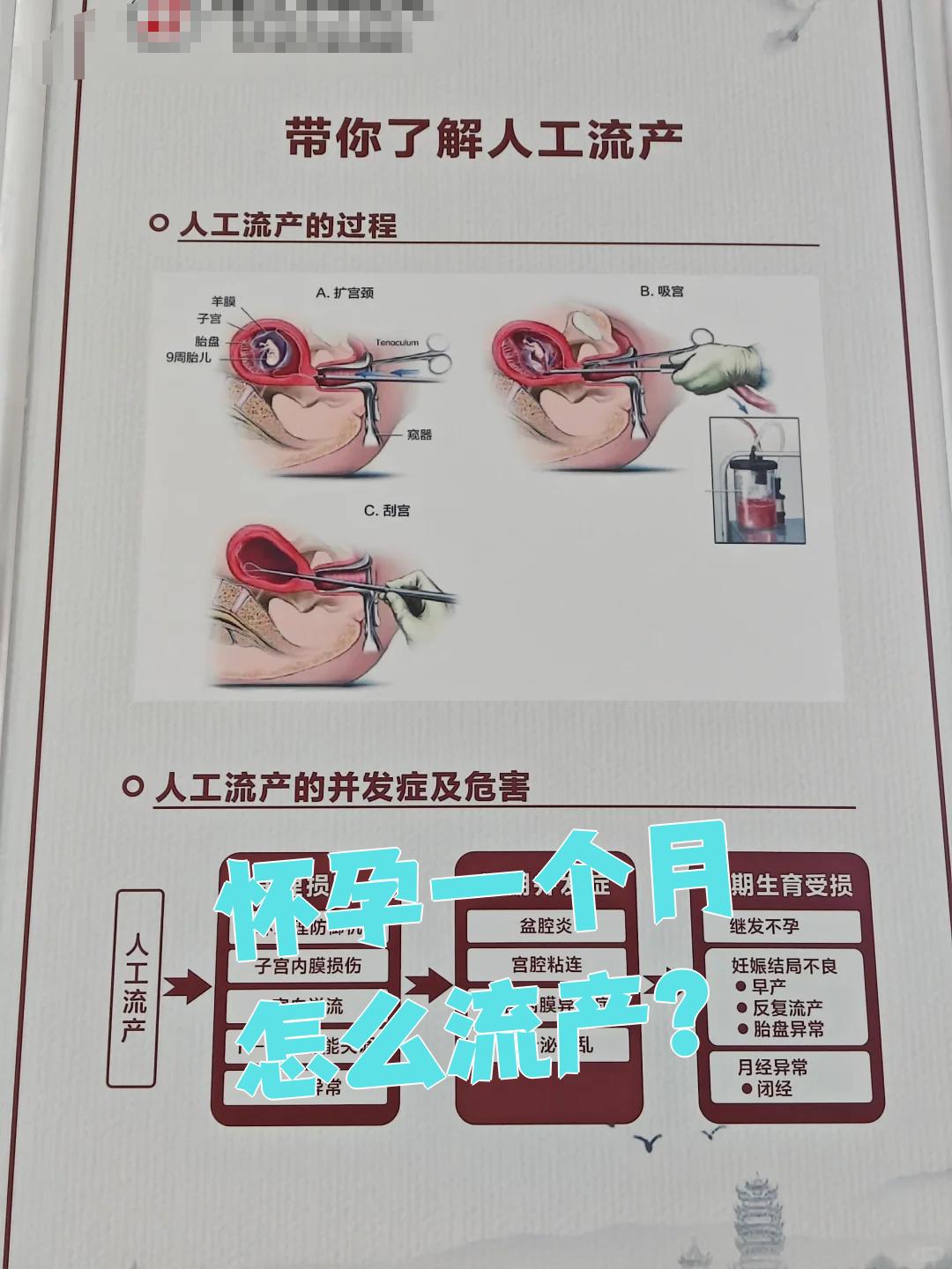怀孕几天可以做人流吗