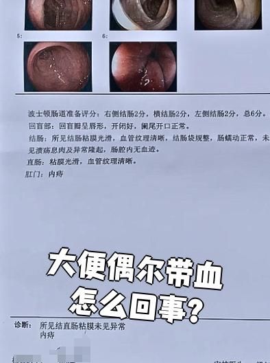 上大便会出血是怎么回事