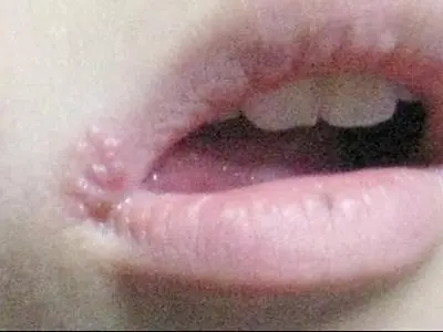 嘴角里长了一个白泡是什么鬼