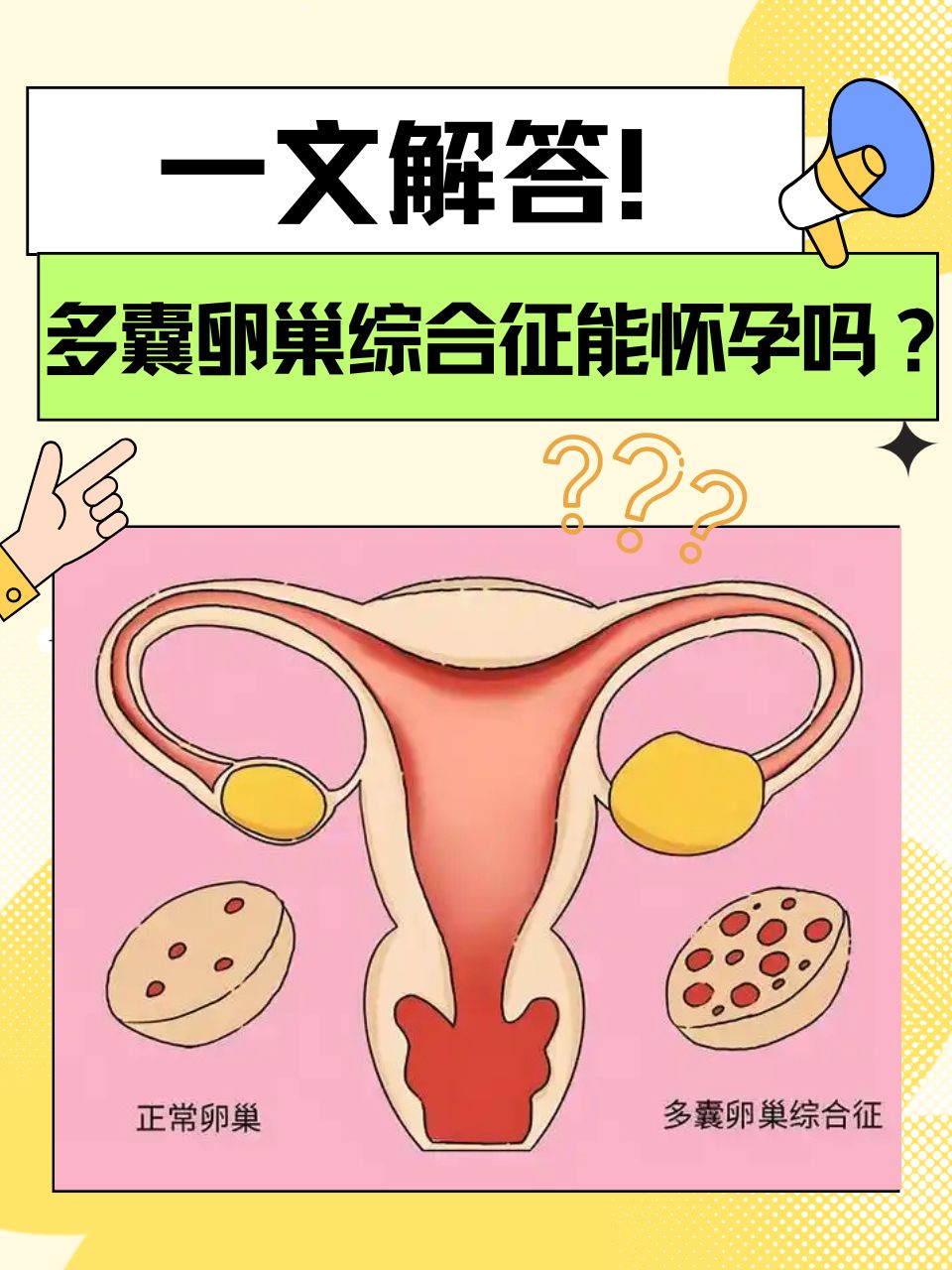 多囊性卵巢综合征是什么