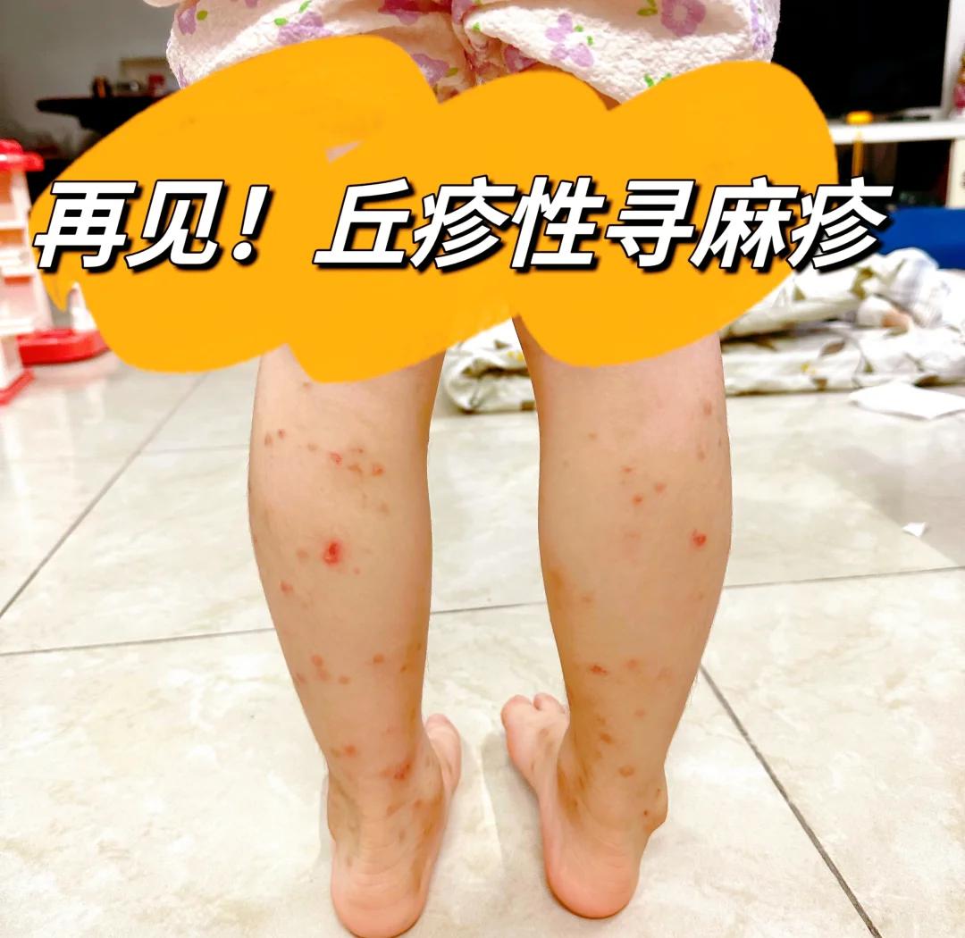 宝宝荨麻疹怎么办