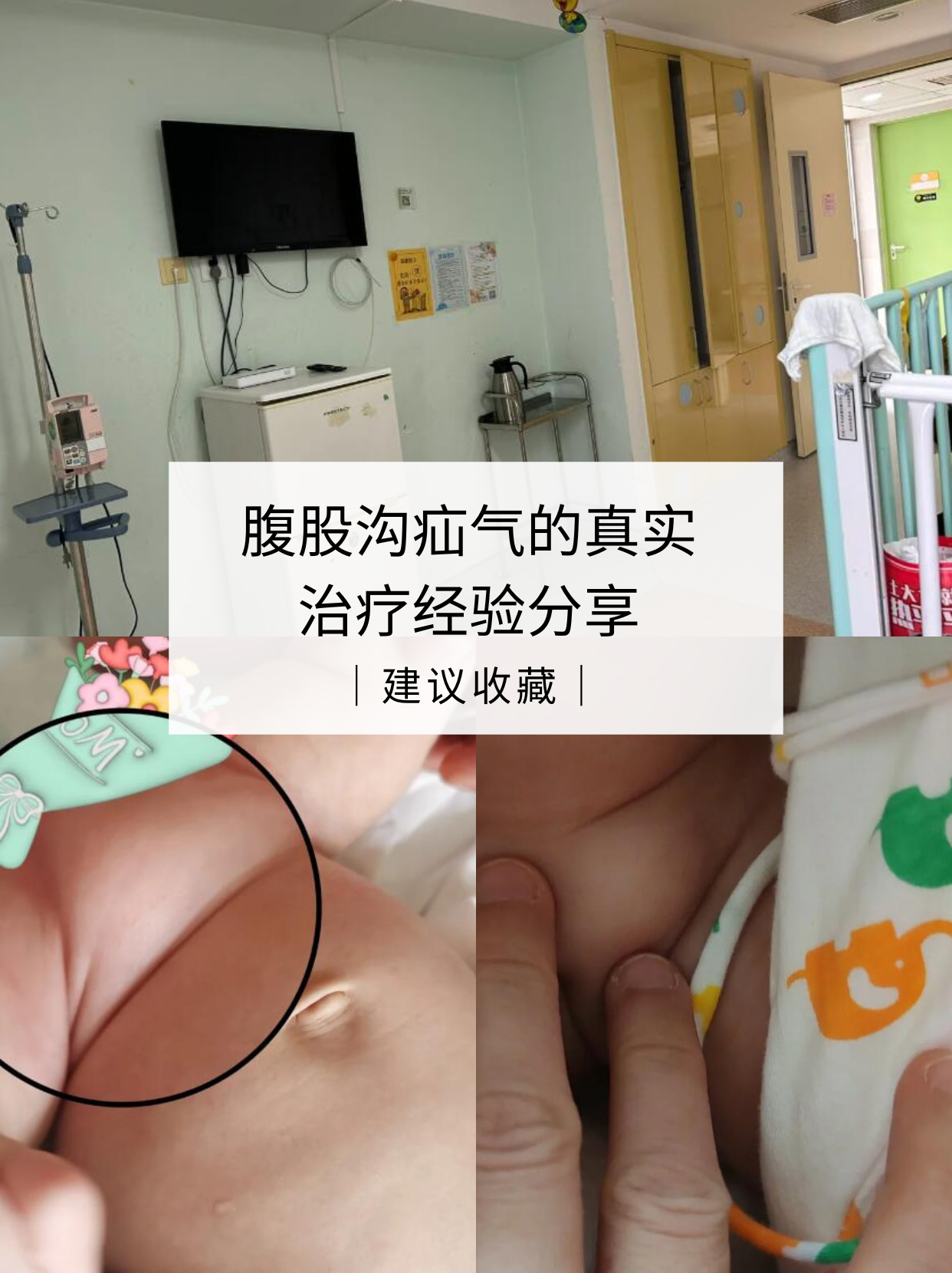 腹股沟疝修补手术方式