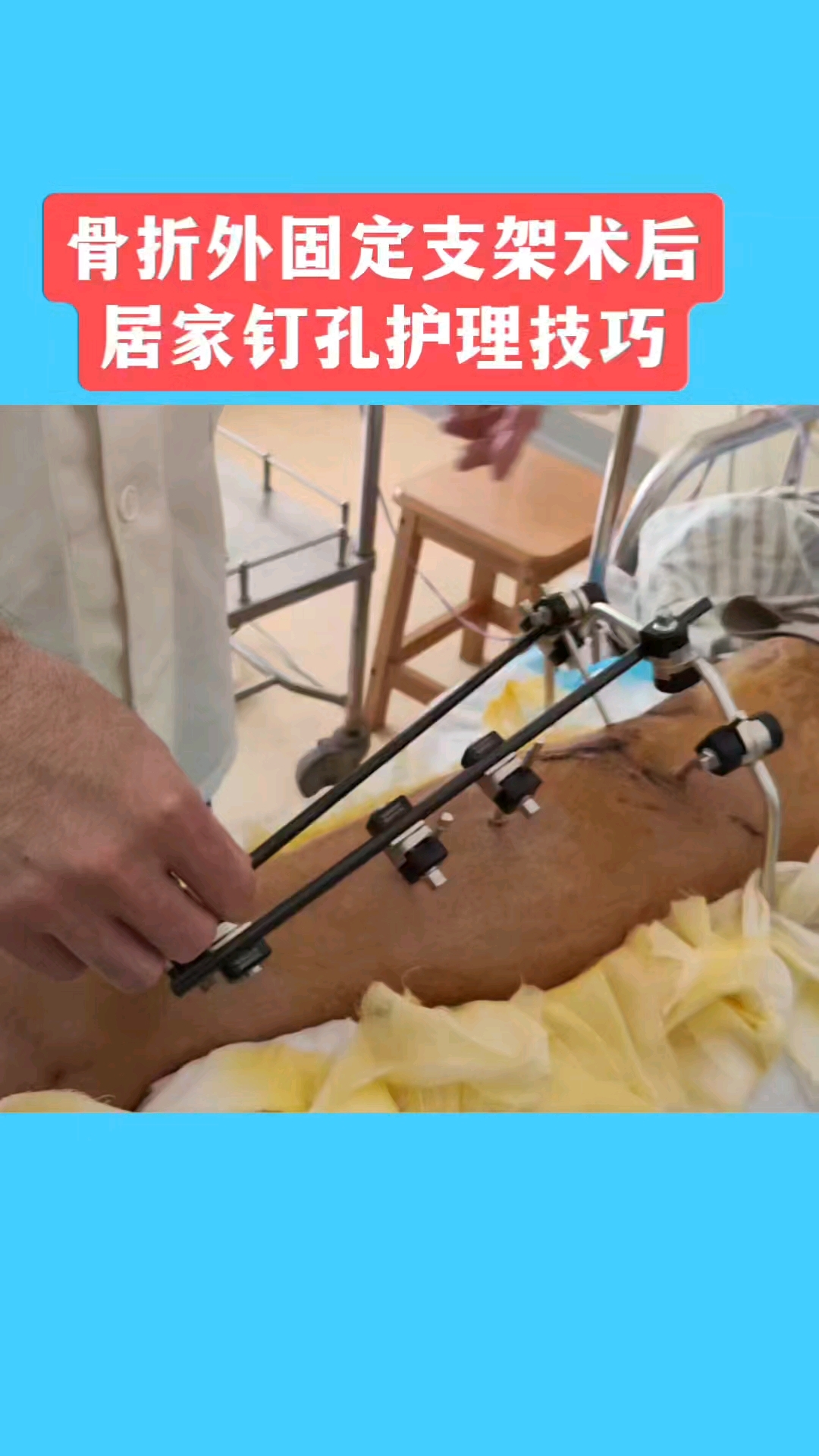 骨折固定的目的是什么