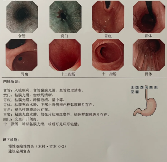 慢性萎缩性胃炎的症状是什么