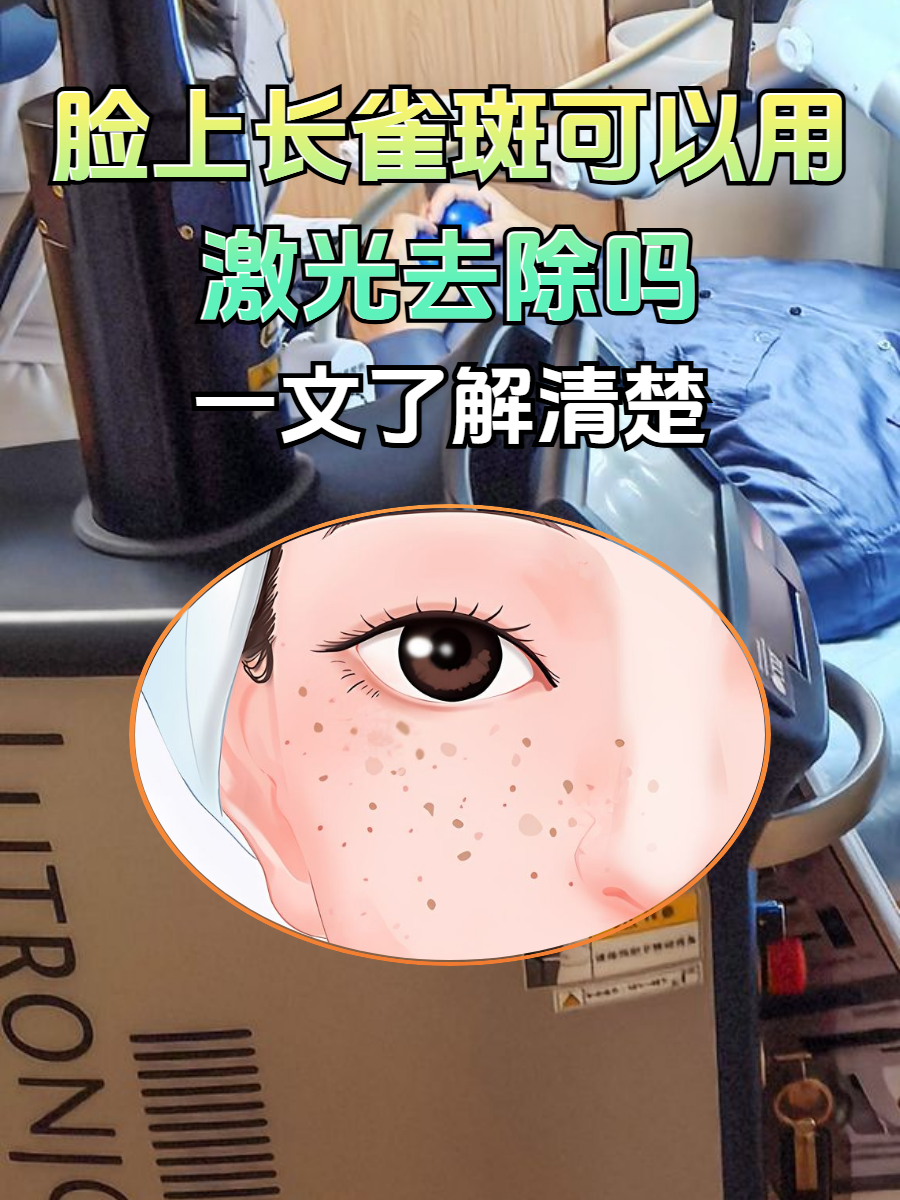 雀斑会自己消吗??