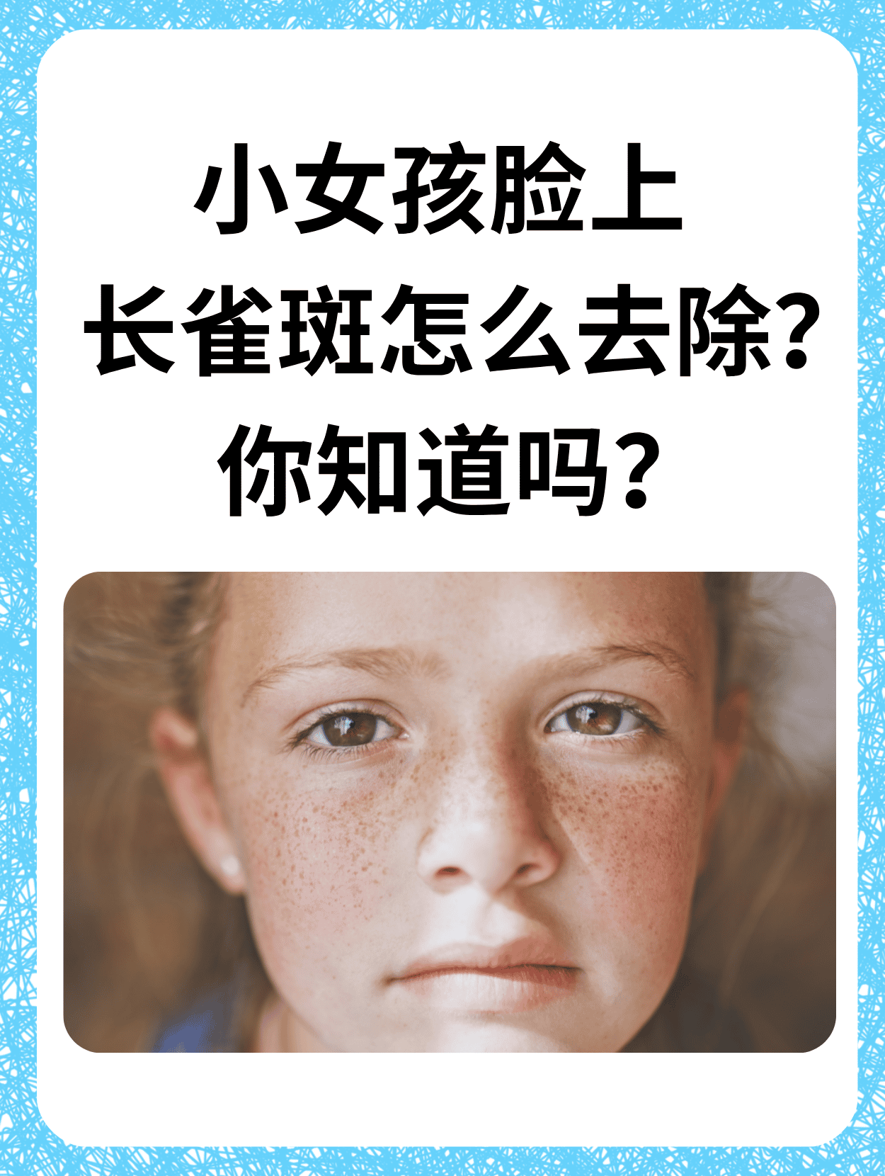 雀斑会自己消吗??