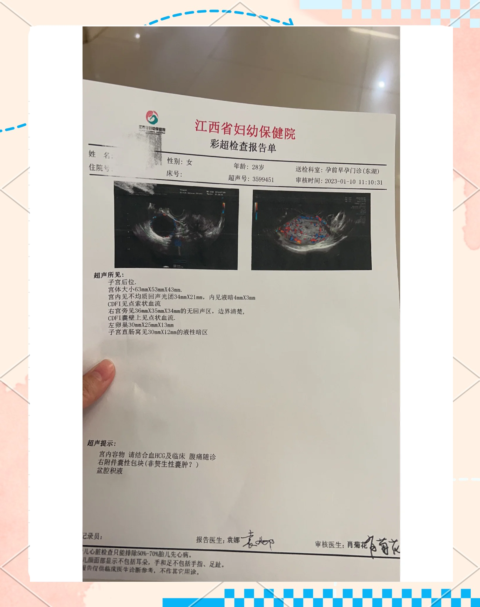 盆腔积液多少算正常