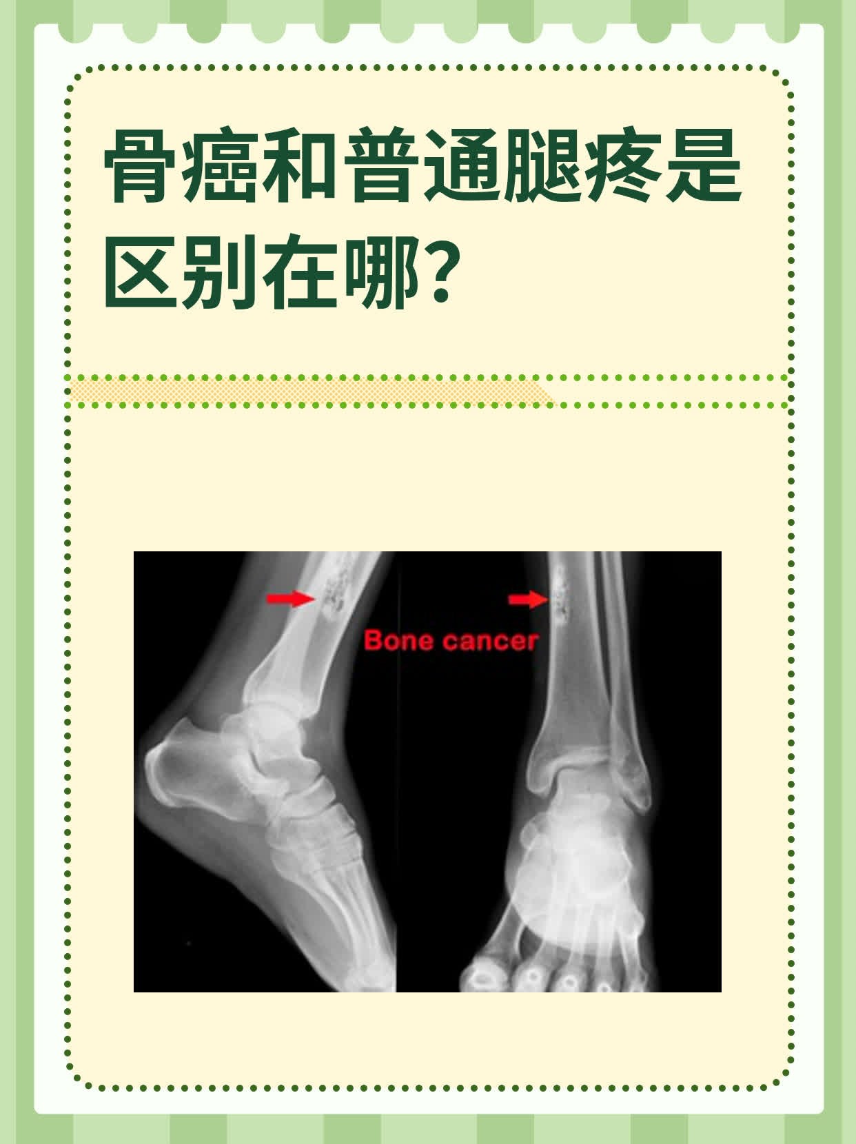 骨癌是什么原因引起的?