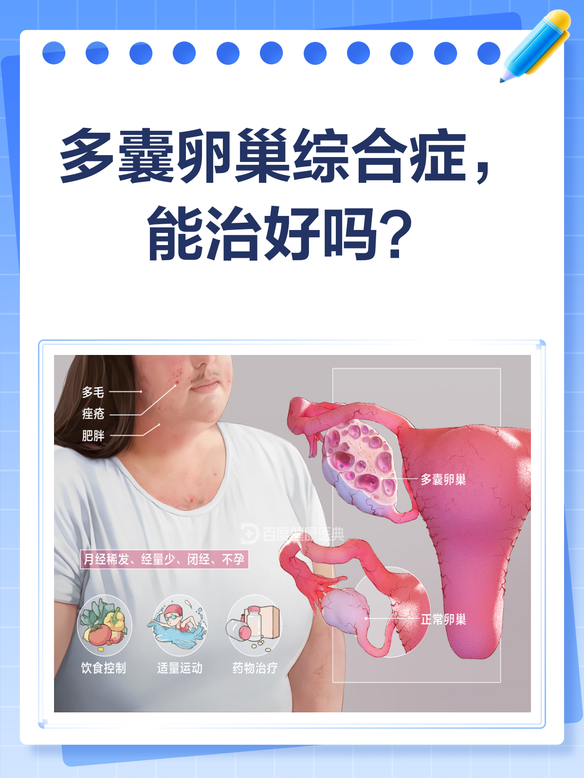 多囊卵巢大概多久能治好