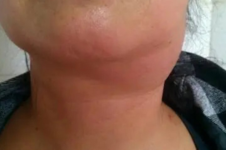 白血病都有什么症状?