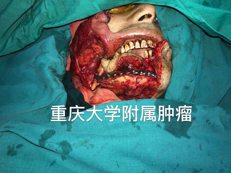 牙龈癌的症状