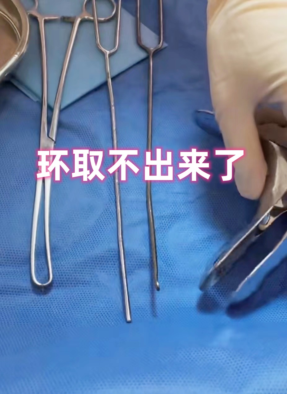 取环手术是什么
