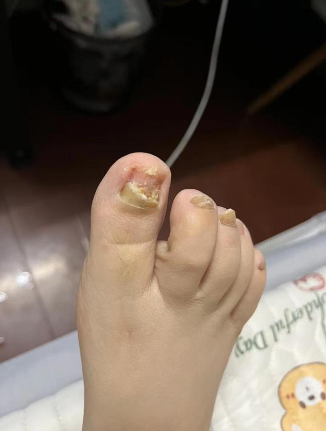 脚趾甲发黄,