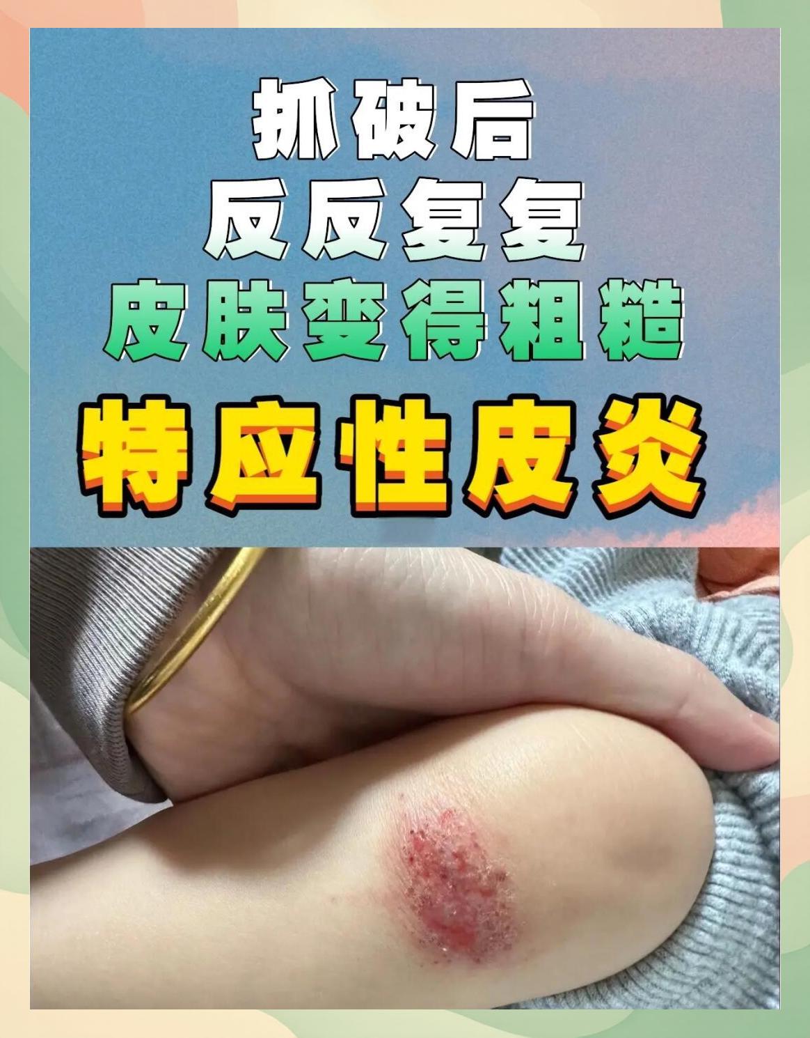 季节性皮炎怎么办