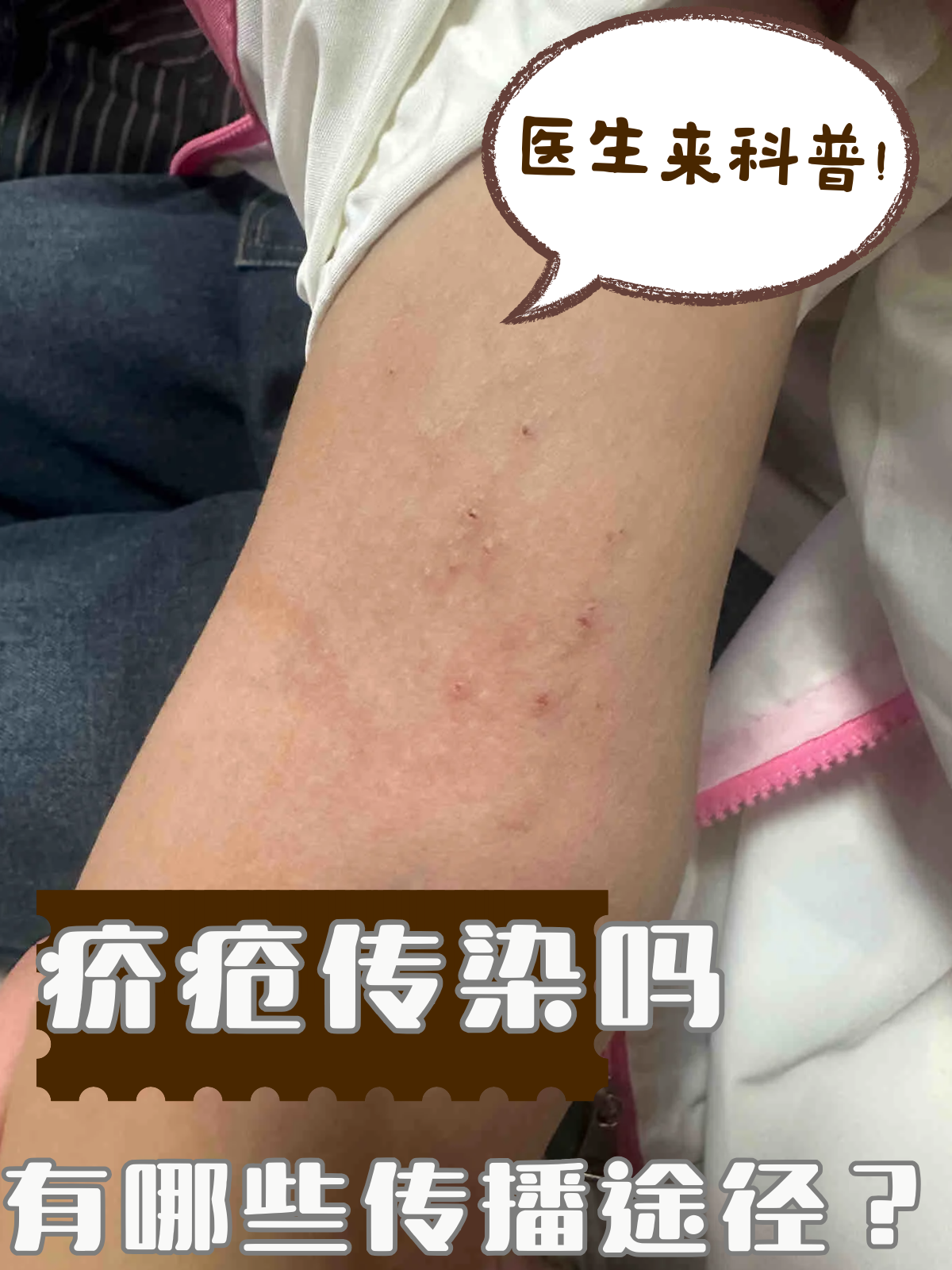 疥疮如何治疗