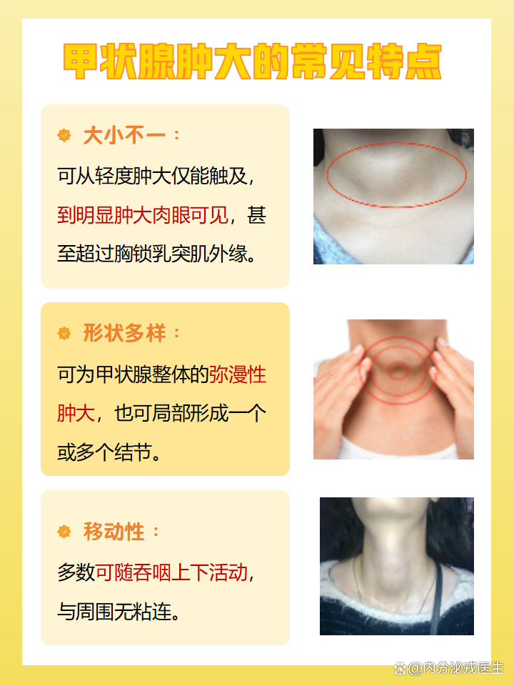甲状腺肿如何治疗