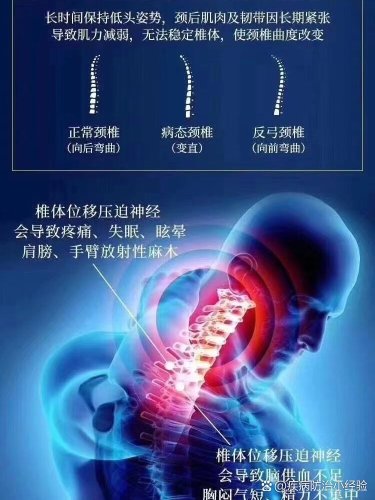 颈椎病分哪几种类型