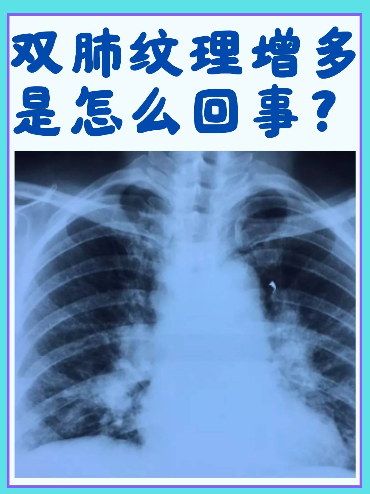 肺纹理增多是怎么回事