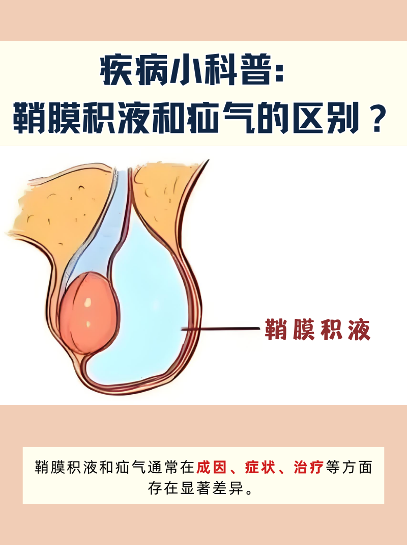 新生儿鞘膜积液