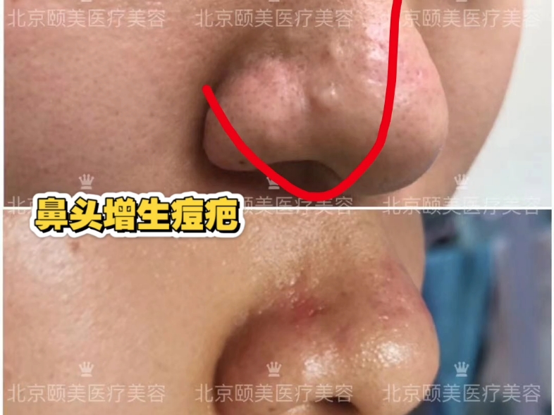 鼻子出油严重
