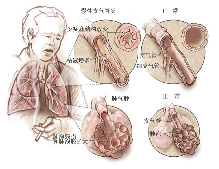 肺部出现的疾病