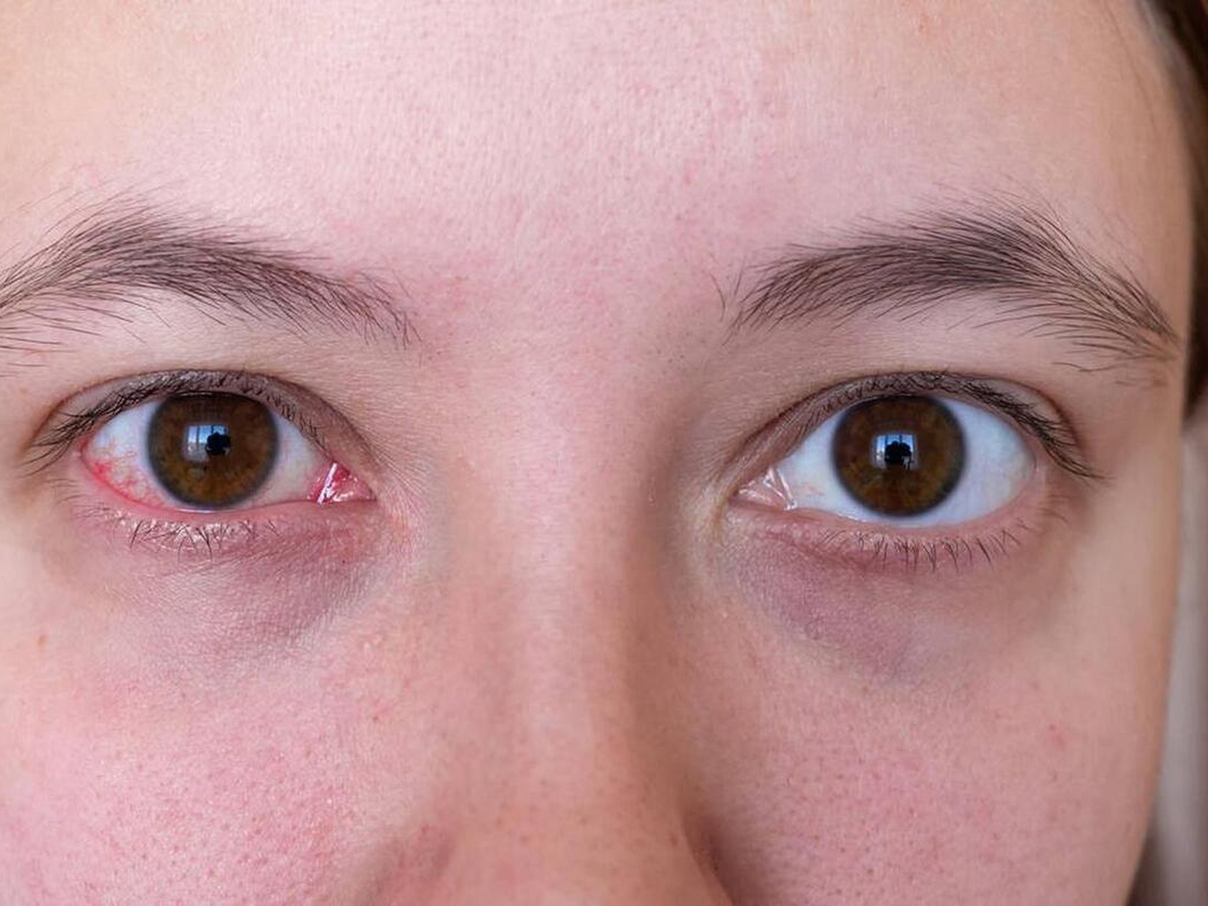 女性血脂高有哪些症状