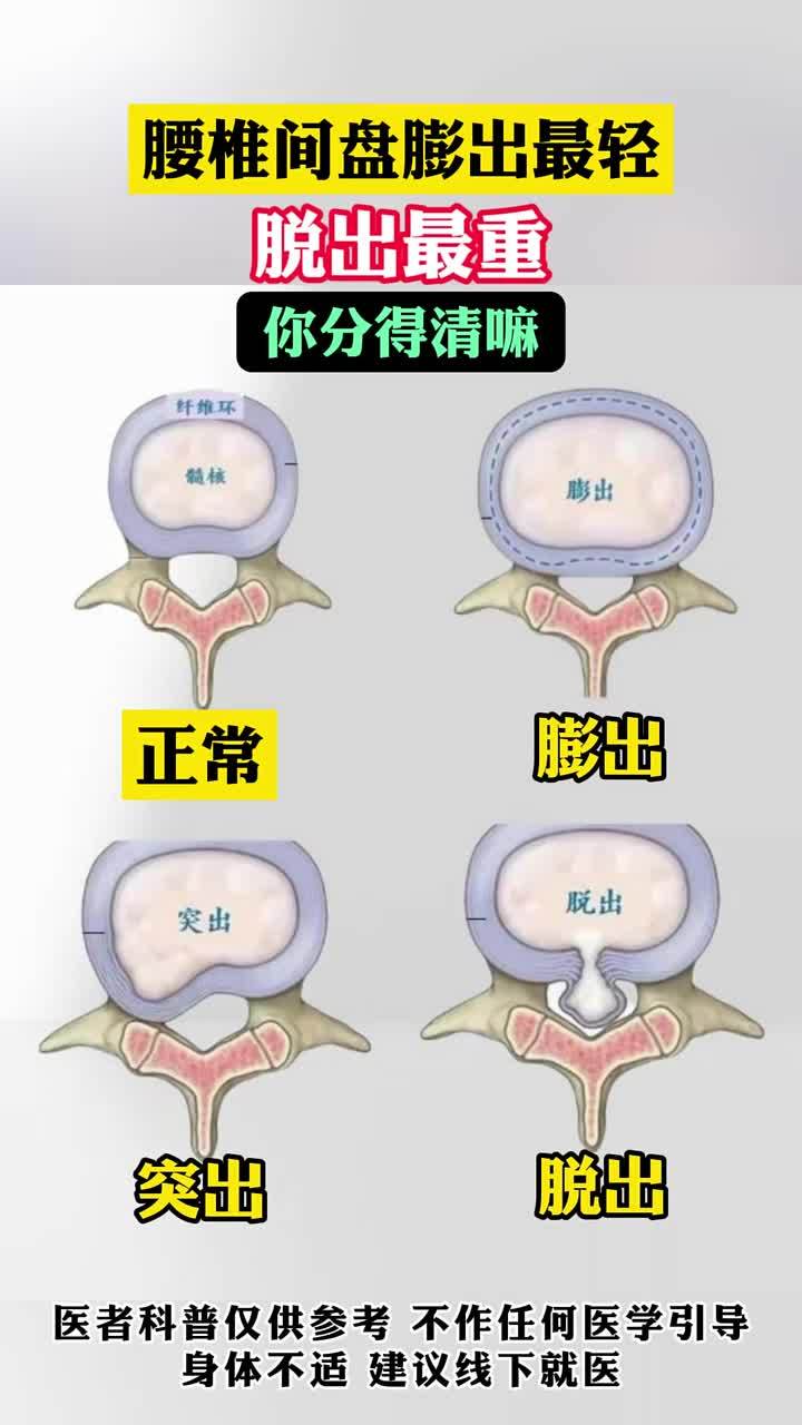腰椎间盘膨出能自愈吗