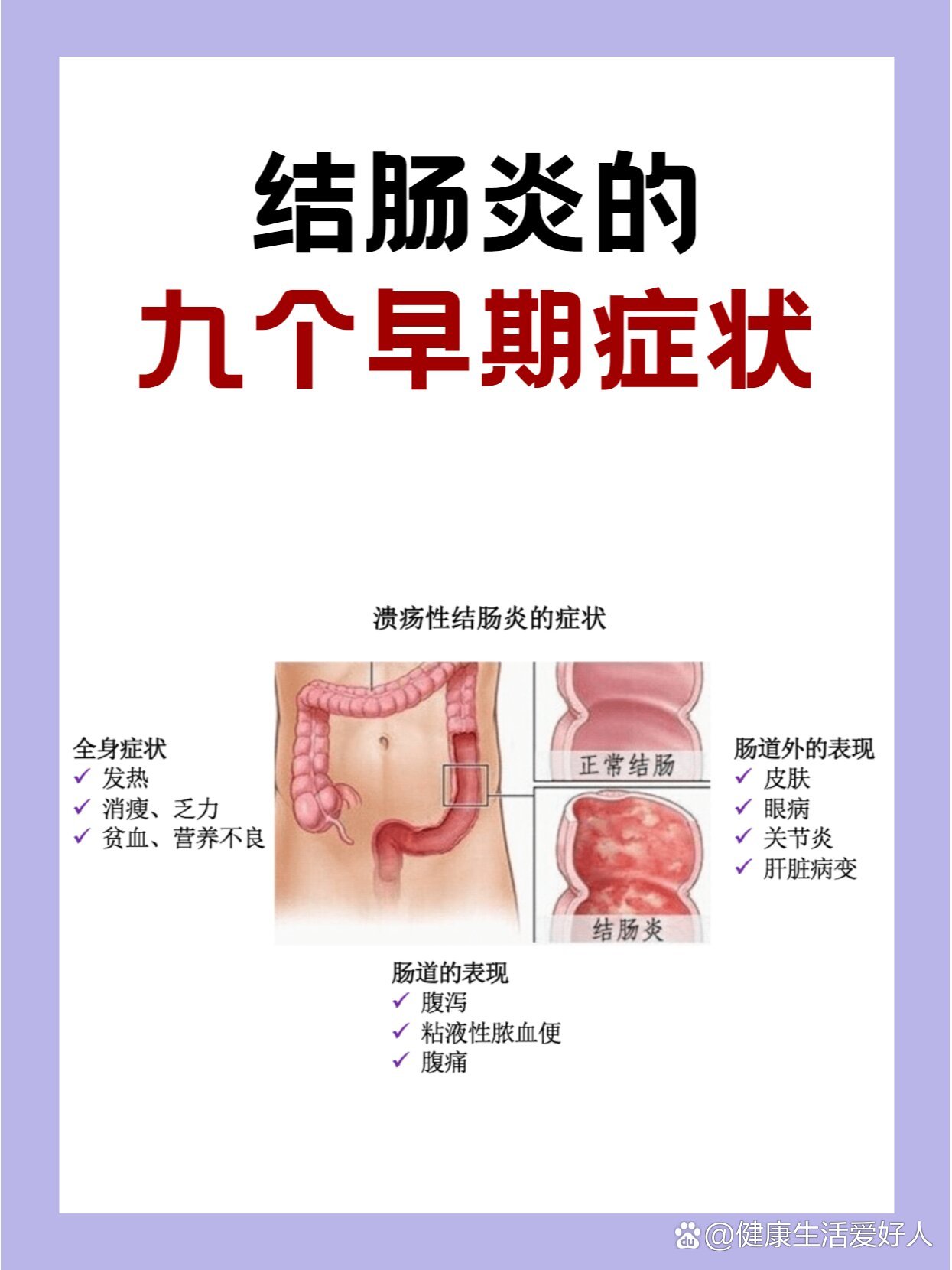 急性肠炎炎症状有哪些