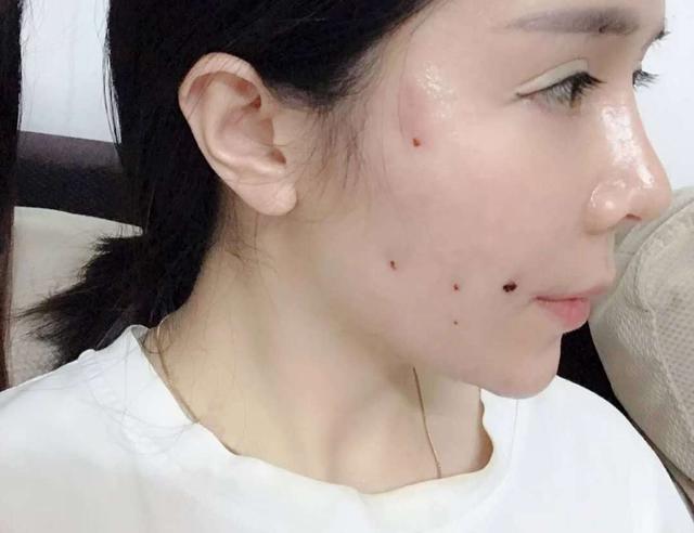 鼻子线雕后的后遗症有哪些